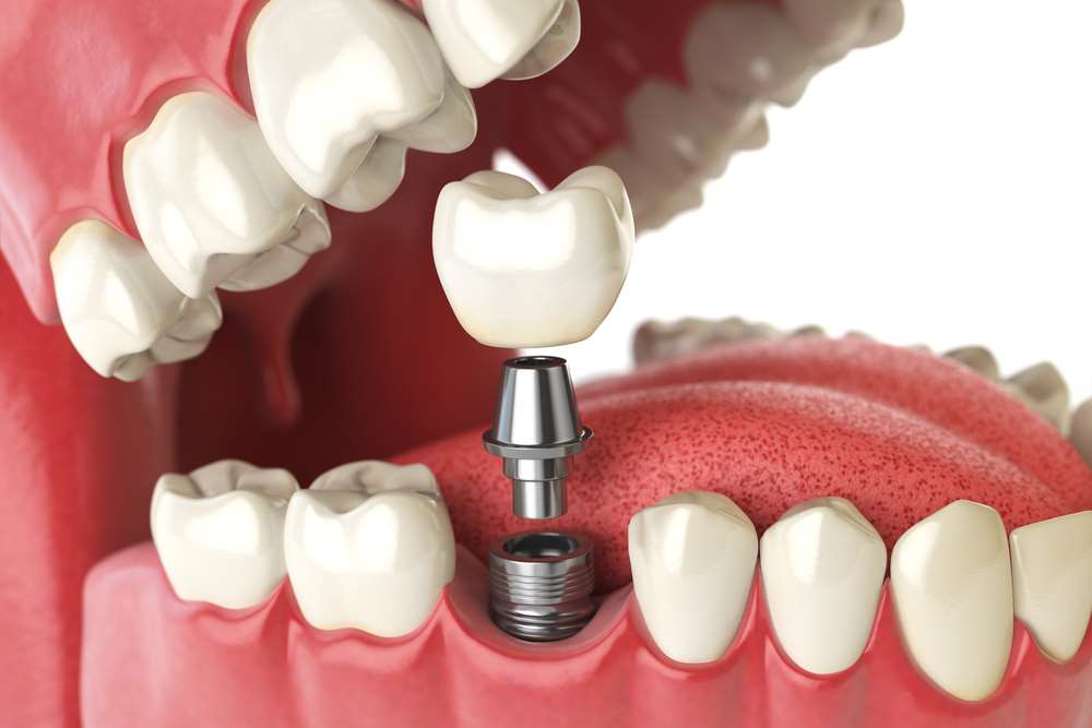 Implantat Aufbau Zahn Zahnarztpraxis München