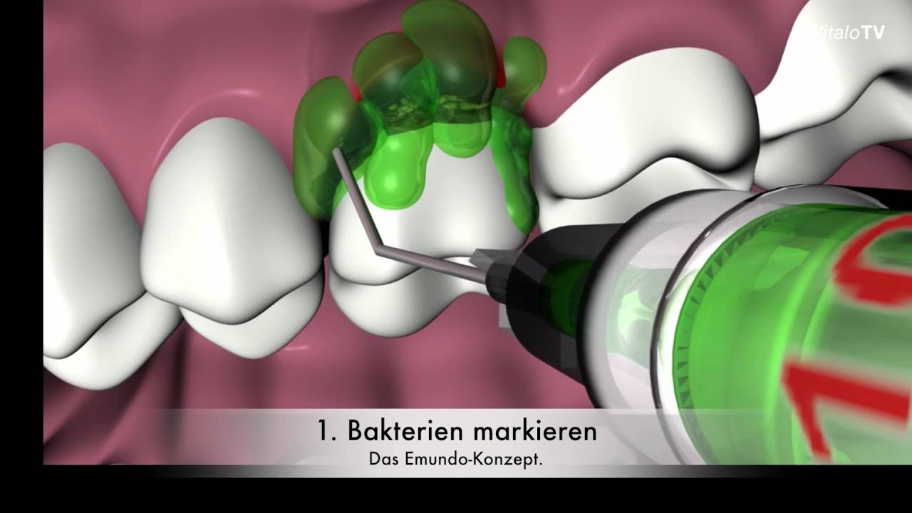 Parodontologie mit Laser — Video 1