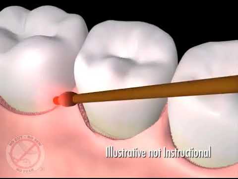 Parodontologie mit Laser — Video 2